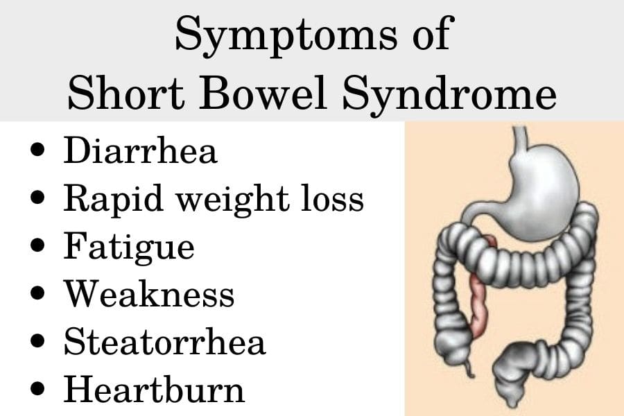 Symptoms of Short Bowel Syndrome