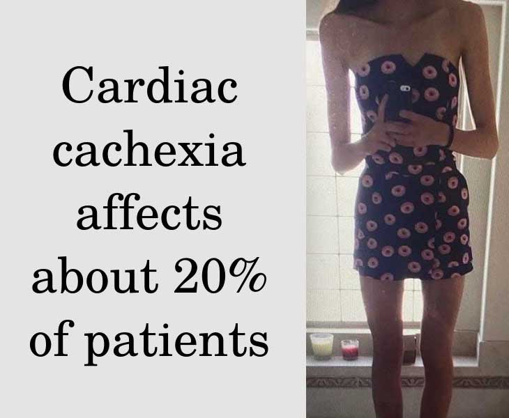 Muscle wasting in patients with chronic heart failure