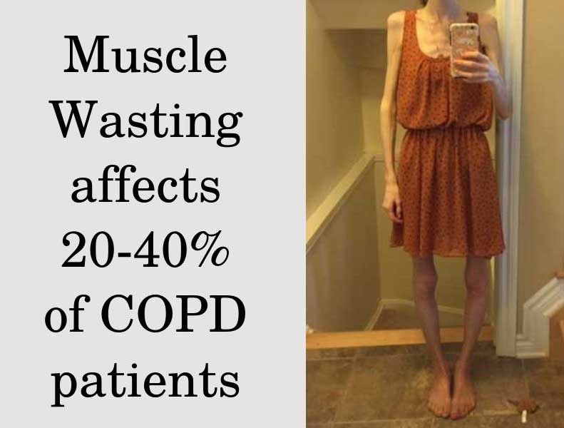Muscle wasting in COPD patients