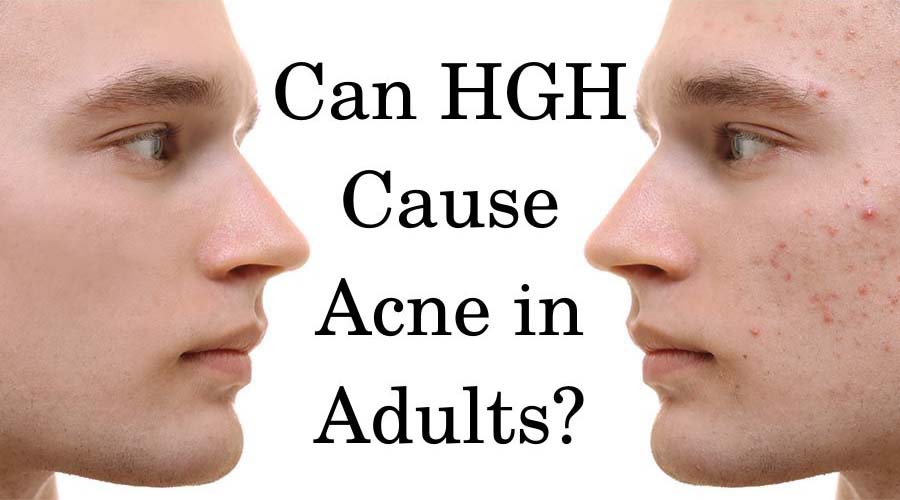 Can HGH cause acne in adults?